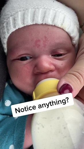 Understanding Marcus-Gunn Jaw Winking Syndrome in Babies