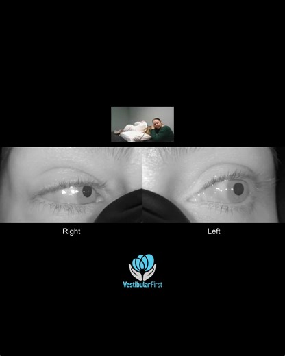 🥸👁️ Is right torsional downbeat nystagmus in the 3rd position/part of a left modified Epley maneuver (nose down position, treating left posterior canalithiasis) usually a good or a bad sign for success of treatment? 🤔❓ Maybe not good, but we'll need to re-test a left Dix-Hallpike after 10-15 minutes to be sure! Right torsional downbeat nystagmus (fancy term: