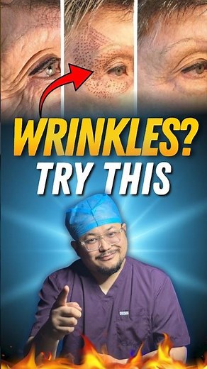 Bye Bye Wrinkles - Plasma Pen Therapy Explained ✅