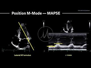 〖Echocardiography〗 MAPSE - left ventricular function with M-Mode