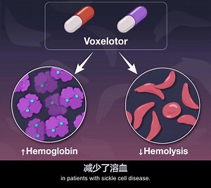voxelotor治疗镰状细胞病