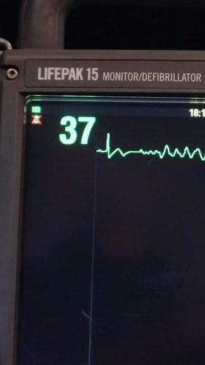 Understanding Cardiac Arrhythmias: Ventricular Fibrillation Explained