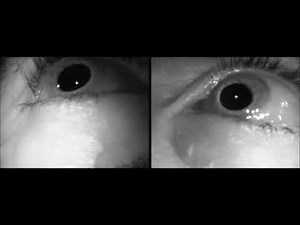 Right Dix-Hallpike test