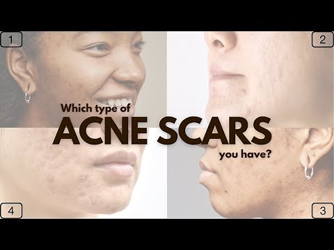 6 Types of Acne Scars & How to Treat Them: Must-Try Brand Recommendations!