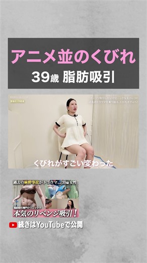 【激変】年齢とともに崩れた体型。脂肪吸引で取り戻す！ #脂肪吸引の森 #脂肪吸引 #お腹痩せ