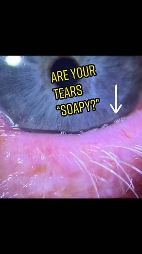 Soothing Tips for Burnt Eyes: Doctor's Advice