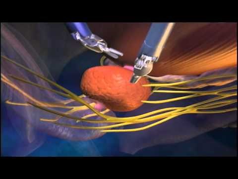 Prostatectomie robotique