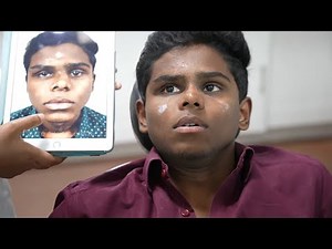 Trauma Rhinoplasty - Rhinoplasty Surgery after a Broken Nose