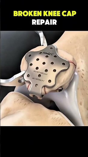Broken Kneecap Surgery Recovery 😳 #kneepain #medical #surgery #viral