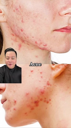 Azelaic Acid: Effective Treatment for Acne and Red Marks