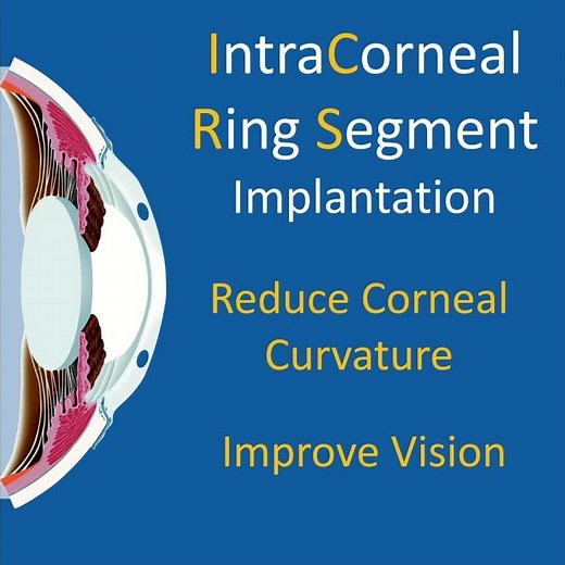 Intracorneal Ring Segment (Intacs) Implantation in Advanced Keratoconus