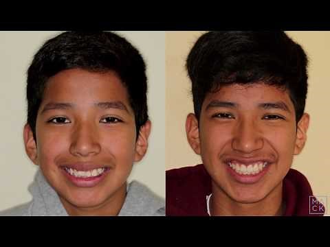 Traditional Braces to Fix Severe Overbite, Overjet, and Crowding (with Extractions)