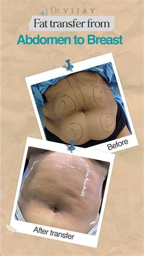 Natural Breast Enhancement with Fat Transfer | Dr. Vijay Bhattiprolu