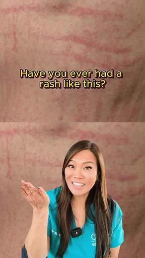 Sandra Lee, MD, FAAD, FAACS on Instagram: "Be careful with your mushrooms!🍄⁠ ⁠ Shiitake flagellate dermatitis is a distinctive rash that can occur from eating raw or undercooked shiitake mushrooms. If you think you have shiitake flagellate dermatitis, stay out of the sun until it clears up or see a dermatologist! 🚫☀️ ⁠ ⁠ #drpimplepopper #Popaholics #pops"