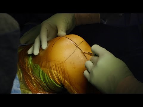 Mako Total Knee Arthroplasty (TKA) Surgical Technique