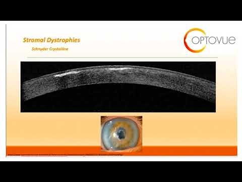 OCT Interpretation Session 9 Cornea and Angle