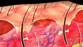 Second Degree Burn stock footage. Video of scalding, chemical - 72509468