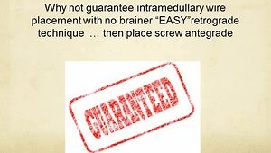 Jones Fracture Intramedullary Screw “The easy way”