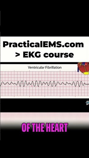 Ventricular Fibrillation: Unstable Rhythm and Cardiac Arrest Explained