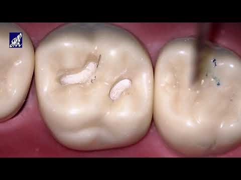 Class I Cavity Preparation Tooth #16