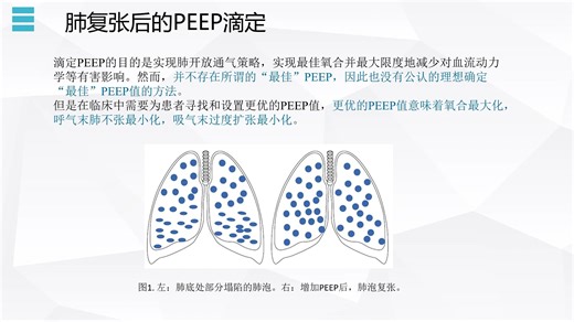 ARDS患者的PEEP滴定