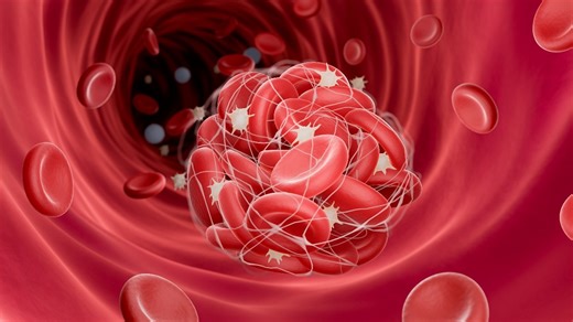 What is TTS? The rare blood clot triggered by AstraZeneca's Covid vaccine