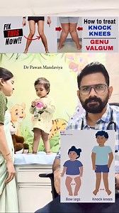148K views · 1.1K reactions | Shape of Legs Abnormal?? ❌Knock knees or Genu Valgum in kids!!!.#knockknees #bowlegged #bowlegs #genuvalgum #physiotherapy #wsitting #wsittingposition #sitting #sittingpose #sittingposition #posture #posturecorrection #precautions #toddler #1yearold #1stbirthday #thingstoremember #instagood #reelsforday #reeloftheday #reelsindia #reelsinstagram #viralvideos #reelsviral #drpawanmandaviya #drpawan_clinic | Dr Pawan Mandaviya | Facebook