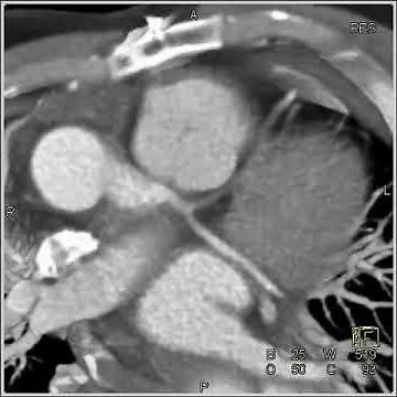 Cardiac: prosthetic aortic valve (1 of 4)