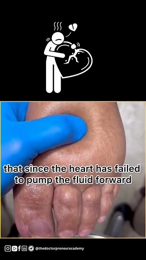 86K views · 506 reactions | Edema means swelling. It’s a common sign of heart failure because the heart can't pump blood properly. When the heart gets weak, fluid starts to collect in the body — mostly in the legs, feet, and sometimes even in the lungs. 例 #hearthealth #edema #heartfailure #medicalfacts #healthawareness #medstudentlife #cardiologybasics #learnmedicine #simplemedexplained #bodybasics | Dr Pranav Sharma | Facebook