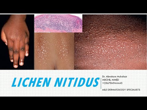 LICHEN NITIDUS BY DR ABRAHAM#educational #lecture #dermatology #science #dermatologist