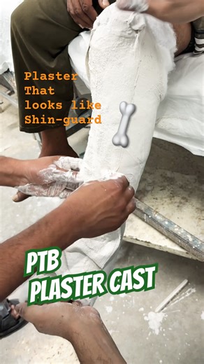 PTB cast:Patellar-Tendon-Bearing plaster cast| #fracturetreatment #fracturemanagement #feeds #shorts