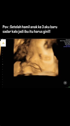 Reni&Khaidir Family on Instagram: "Saat tau hamil anak ke 3 pas usianya 5 bulan dalam kandungan,aku kayak jadi flash back kehamilan sebelum2 nya ,,ada yg sama nggak lahiran secara sc? Jadi aku punya anak semuanya lahir sc,,bukan karena pengen karena mmg kondisi harus sc.,dan saat tau hamil anak ke 3 ,,boom kayak kefikiran gimana nanti lahiran,,dibius ditulang belakang lagi dan ngilu 😭,,kebayang dinginnya kamar operasi dibius Ya Allah takut itu terus membayangi saat hamil,,perut semakin membesar