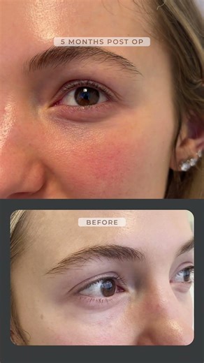 Lower blepharoplasty with fat repositioning fat grafting to midface co2 laser