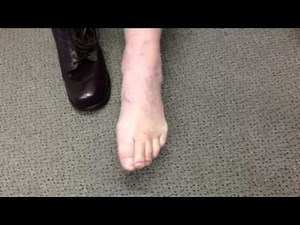 Movement after Ankle Fusion