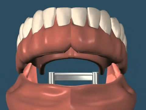 Prótese Total Sobre Implantes com Barra Clip - Unitária