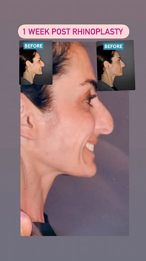 Dr Sam Rizk on Instagram: "44 yo patient first time rhinoplasty shown 1 week post with a nose that better fits her face and creates more balance . Also note by bringing down a large bump with overprojected nose it brings out eyes more puts attention more on eyes rather than nose . She is doing great and we are happy for her . #rhinoplasty #rhinoplastyspecialist #rhinoplastynyc #rhinoplastyexpert #bestrhinoplastysurgeon #rhinoplastyusa #rhinoplastydubai #rhinoplastykuwait #rhinoplastymiami #rhino