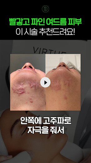 빨갛고 파인 여드름 흉터가 고민이라면 버츄레이저 #shorts