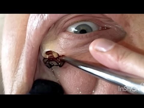 Tooth Extraction of a Broken Molar – You Won’t Believe the Twist! 😱😱😱💔