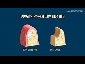 ECM Guide 나노기술 기반 덴탈 멤브레인 사용법 GBR, IGBR, Open Membrane Technique 적용)