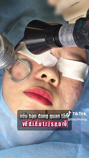 Sẹo rỗ lâu năm: Phương pháp điều trị hiệu quả