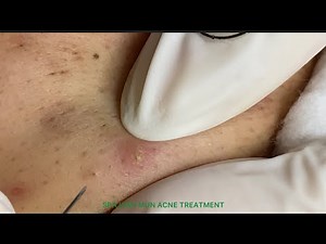Acne treatment under the skin #007 / Spa Linh Mun