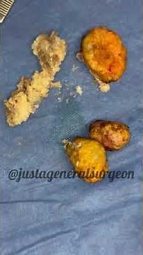 Inside the OR with ‪@justageneralsurgeon‬ - cutting open a trio of nasty disgusting pimple cysts 🤢