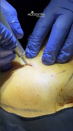 Giant lipoma removal - Hoogstra technique - r26009