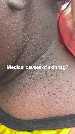 What causes skin tags? Why do skin tags form? The precise cause of skin tags is unknown. They become more common with age and occur more frequently in people with a family history of skin tags. People with metabolic disorders, such as obesity and diabetes, are also more likely to develop skin tags. The exact cause of skin tags is not fully understood, but several factors are believed to contribute to their development, such as: Obesity Human papillomavirus infection Diabetes Genetics Hormone imb
