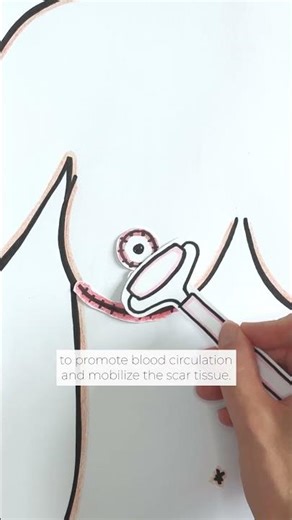 Scar treatment | BRST Mia Clinic Zurich