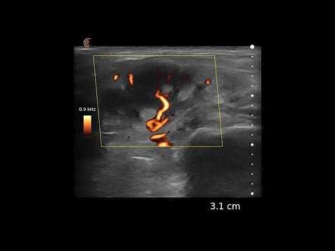 Lymph Node – Ultrasound Image Interpretation