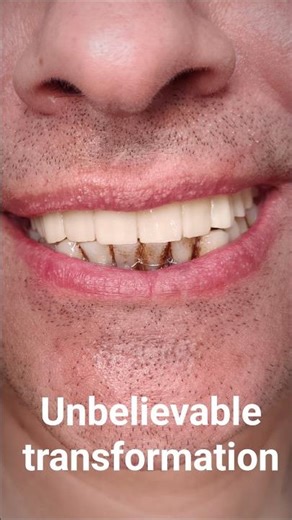 Bad Teeth? Full Transformation with Zirconia Bridges on Implants