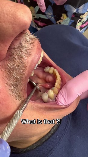 Tooth Abscess: Causes, Symptoms, and Removal