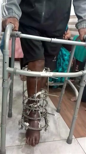 # Ring fixators (e.g., Ilizarov apparatus) 🔥💯✅🥺