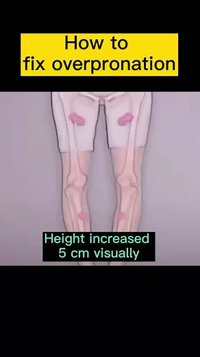 How to Fix Overpronation: Effective Techniques and Tips